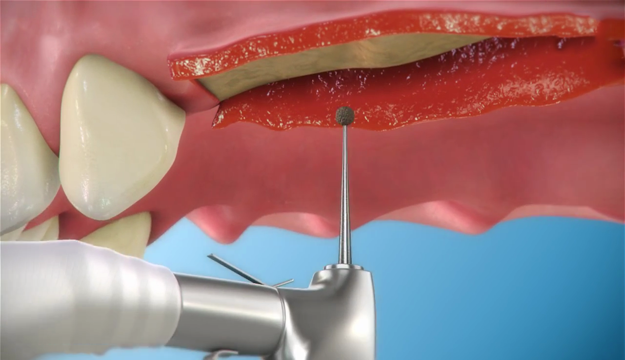 Paso 1 - Sistema DIVA