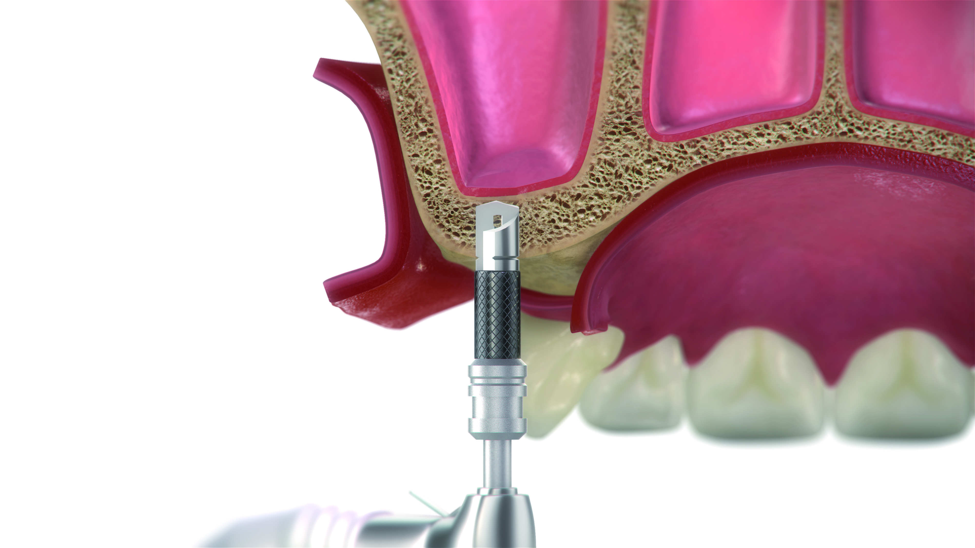 Paso 2 - Sistema DIVA