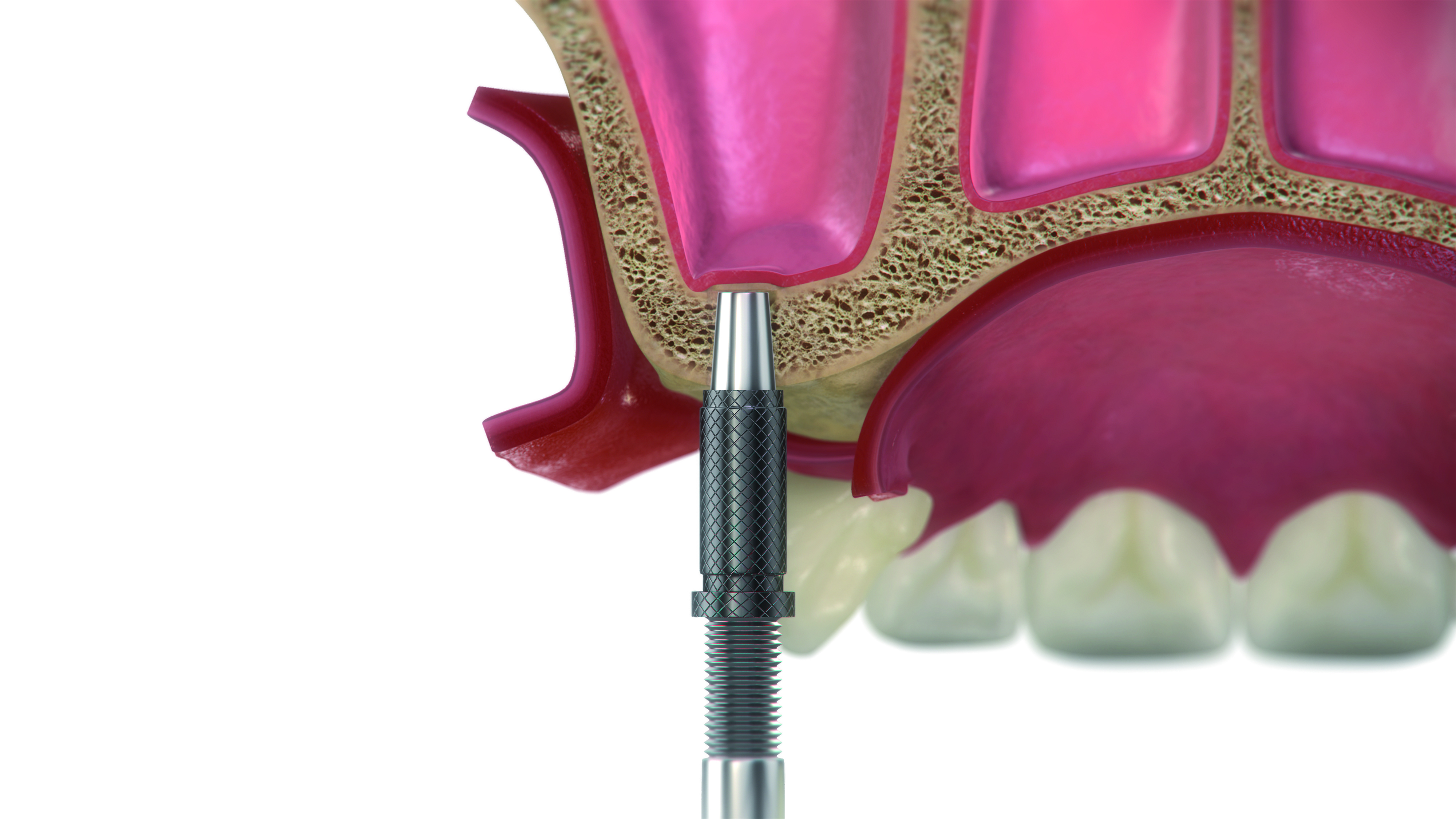 Paso 3 - Sistema DIVA