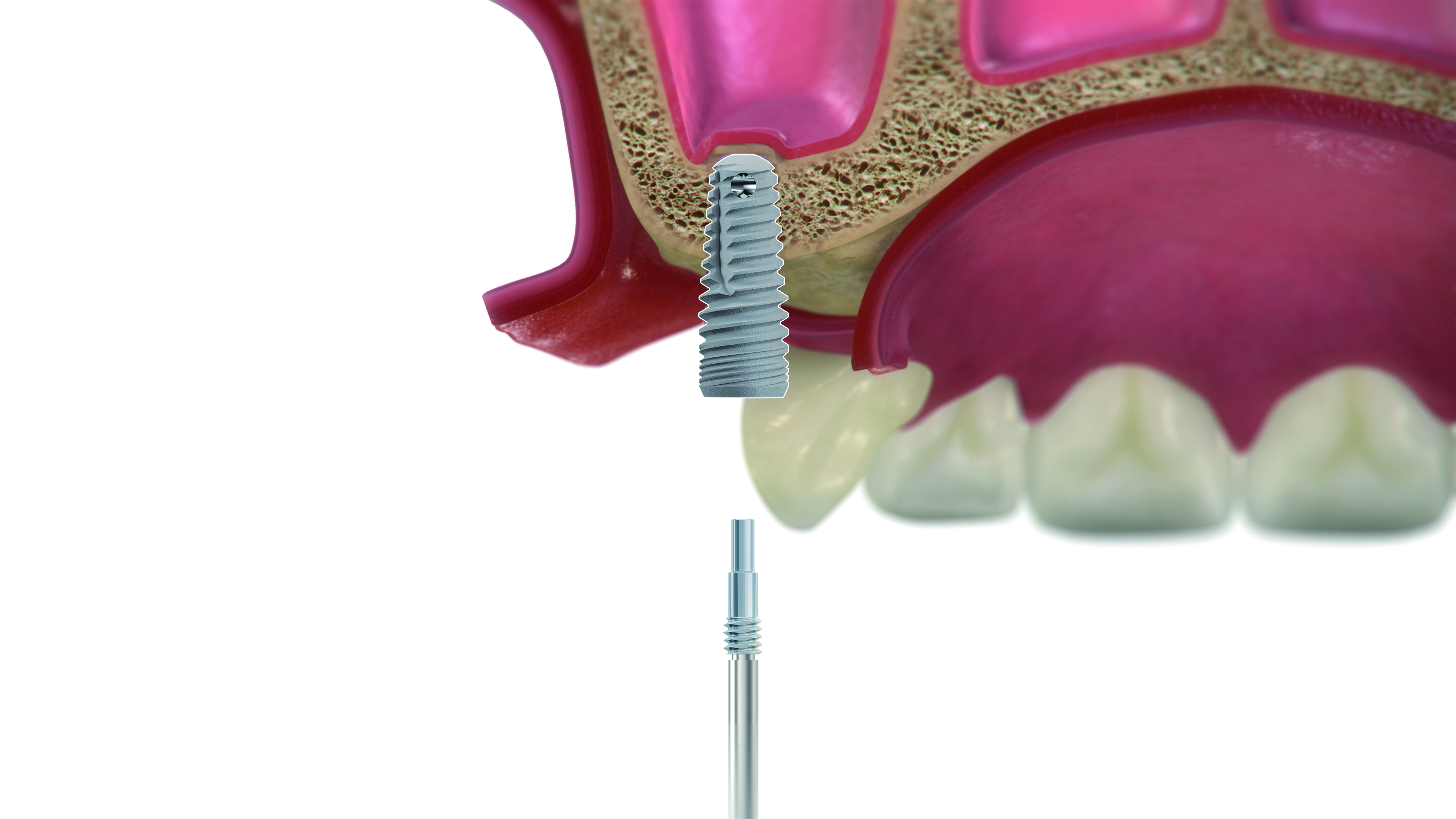 Paso 4 - Sistema DIVA