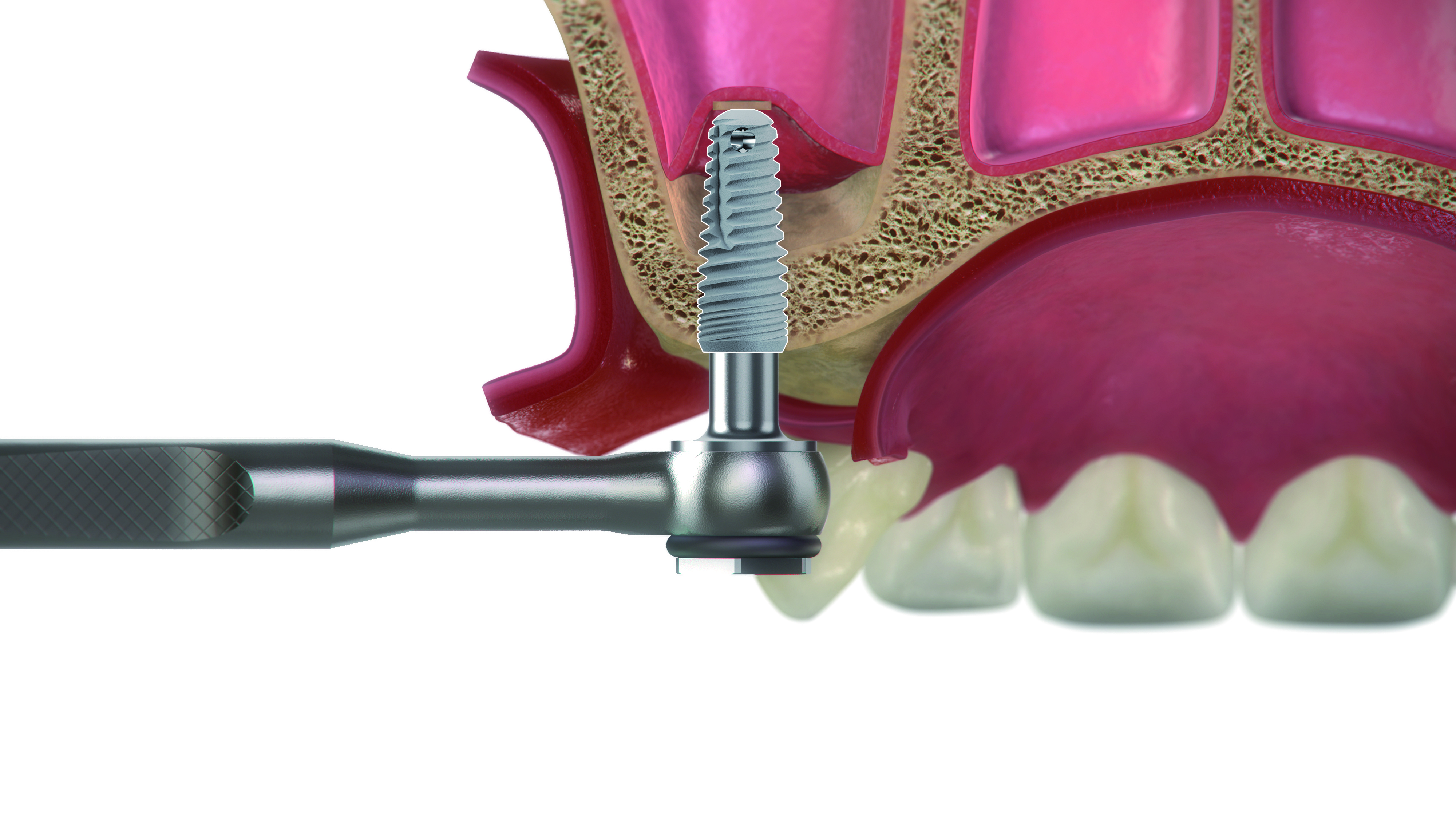 Paso 5 - Sistema DIVA